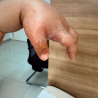 Image_reduite Bulle, vésicules et œdème sur sa main gauche.